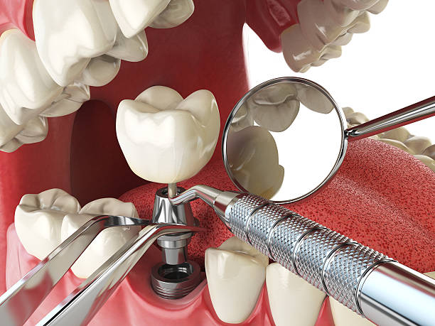 Best Emergency Tooth Extraction in Queen City, TX