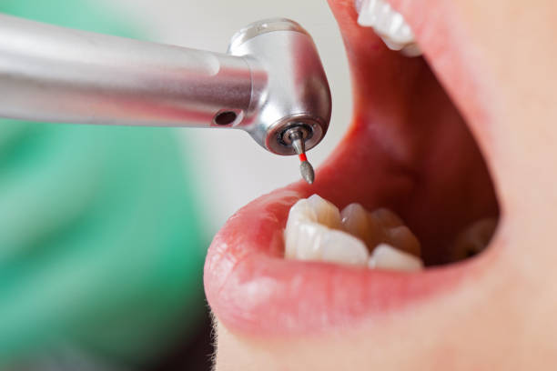 Best Emergency Wisdom Teeth Removal in Queen City, TX